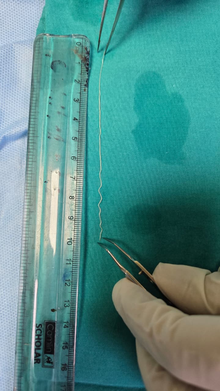 Two days of pain in the eye leads to rare diagnosis;10 cm worm removed safely at KIMSHEALTH